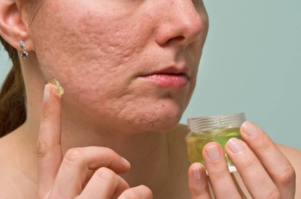 natural products for acne scars